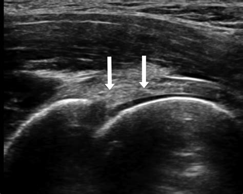 special test to diagnose acetabular labral tears|acetabular tear ultrasound.